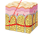 Laser Subcision Laser Subcision