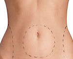 Lipolaser Lipolaser